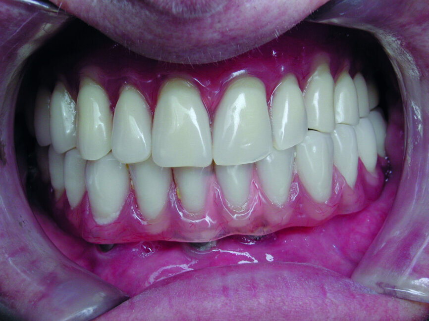 Cas 2c : prothèses en bouche