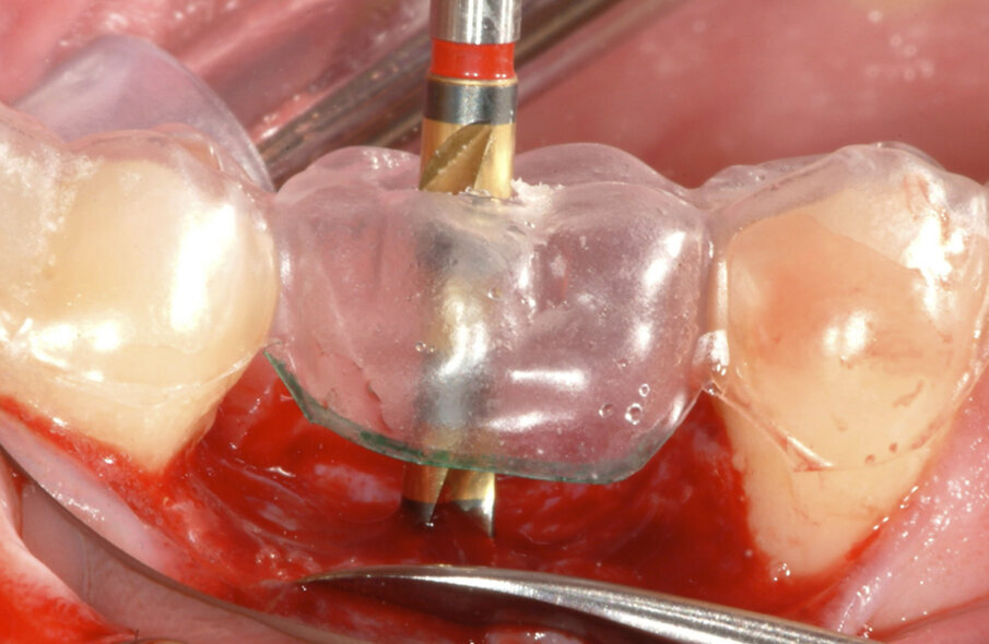 Fig. 6: Using a surgical stent, the osteotomy could be performed in an adequate position in 3D, using the zenith of the cervical contour of the planned restoration as a reference point.