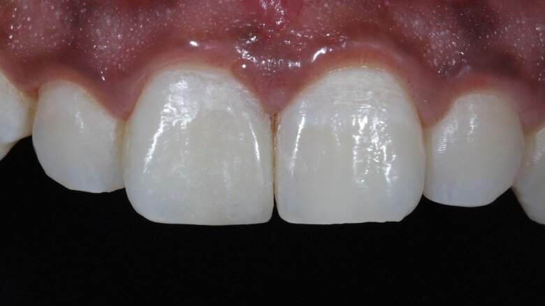 Fig 21: Final Post-Operative photograph