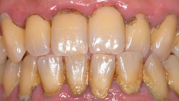 Nuovo approccio al protocollo di full-mouth disinfection