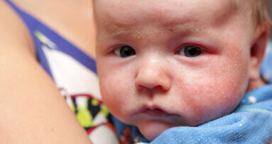 Researchers study link between dental agenesis and atopic dermatitis