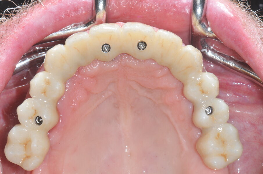 Fig. 5b_Visione occlusale della riabilitazione protesica definitiva.