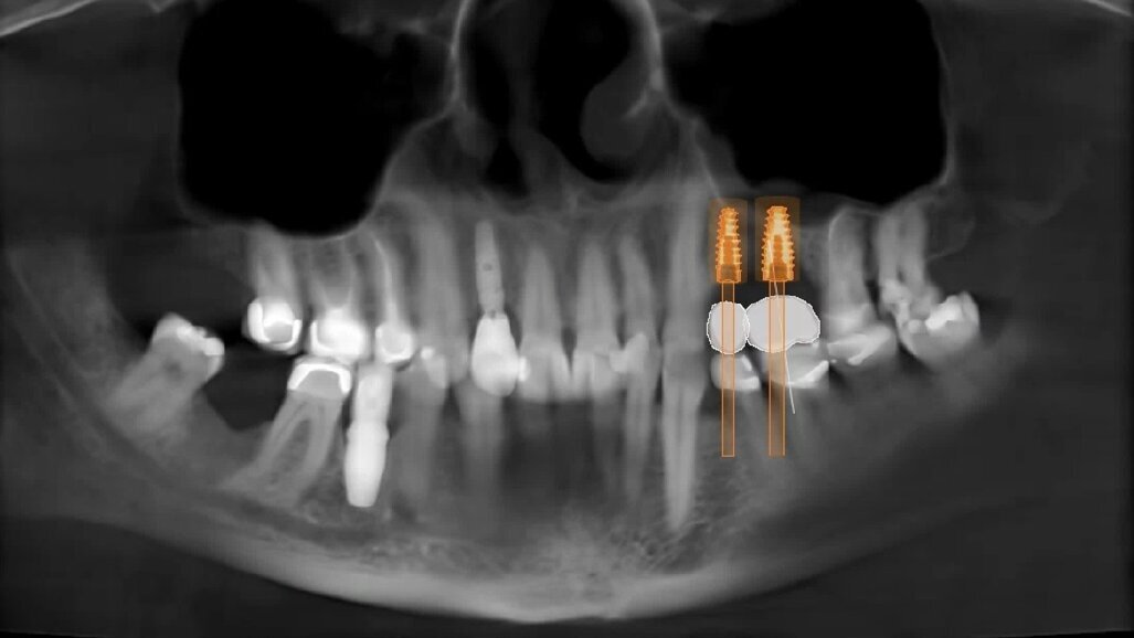 Digital Sinus Planning (DSP) Protocol: Protocollo digitale per programmare una rigenerazione ossea verticale/orizzontale