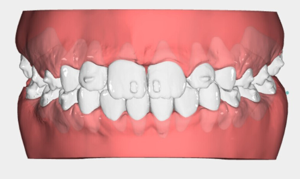 Fig. 8d: Nuvola View images of the impressions for the first phase of therapy, the second phase, the finishing design and the final re-evaluation of the case.