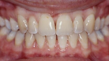 Orthognathic surgery and recovery have different anesthetic requirements