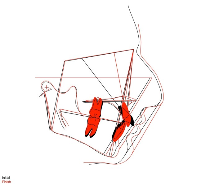 Figs. 9a & b: Pre-treatment (black) and final post-treatment cephalometric tracings (red).