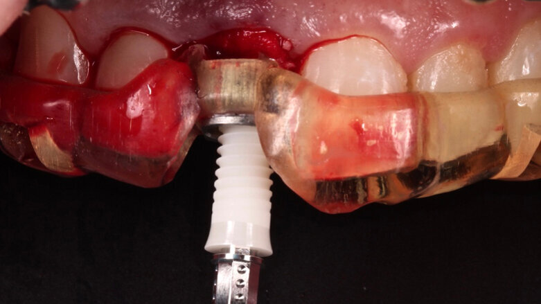 How to attract new patients by offering ceramic dental implants