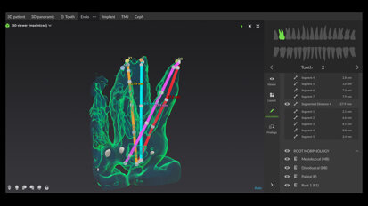 Using digital software for effective root canal therapy