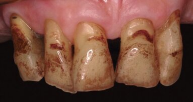 Estética y blanqueamiento dental en la era digital  (Capítulo 2)