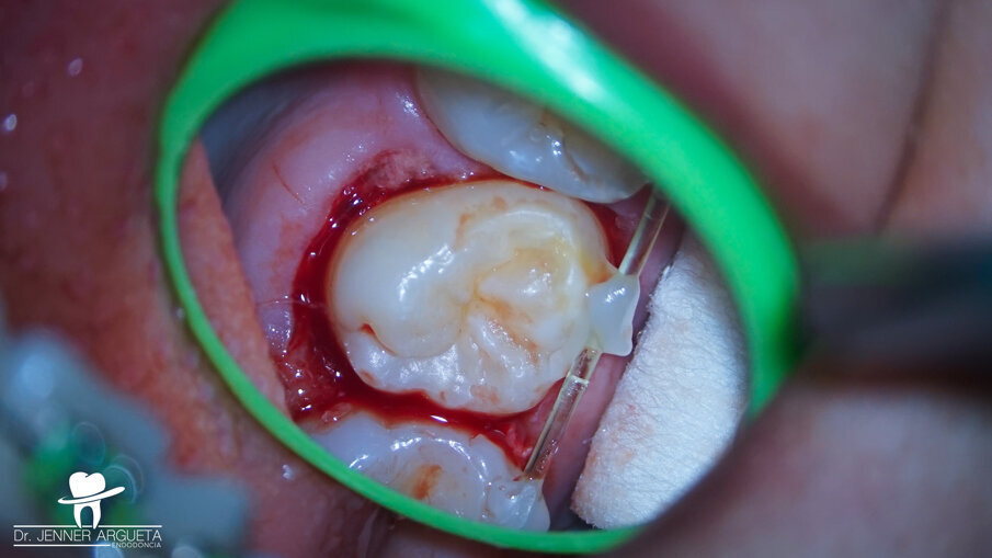 Fig. 4: A nylon monofilament flexible splint was used to stabilise the transplanted
tooth in the recipient site.