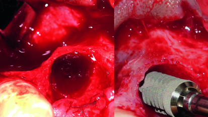 Localized ridge augmentation utilising titanium mesh with CPS morsels and simultaneous implant placement—A case report