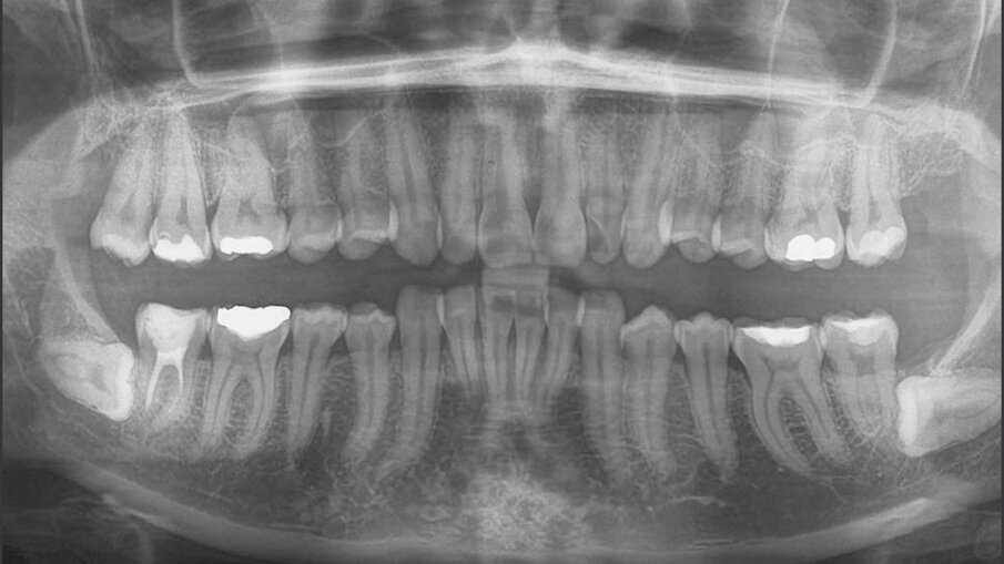 Figg. 3a-3c_Acquisizione dei records radiografici. Tracciato cefalometrico iniziale.