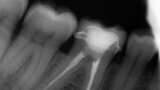 Figs. 12a y 12b. Vista final lateral y oclusal.