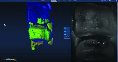 A minimally invasive approach according to biomechanical principles of teeth