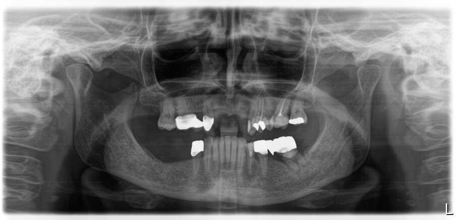 Fig. 50_Radiografia iniziale 