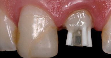 Anatomical pin: A clinical case report