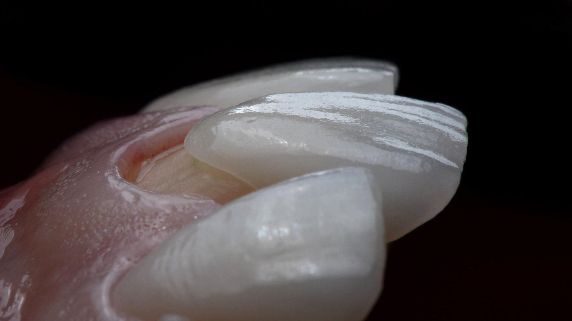 Technology and emotion: A porcelain veneer case report