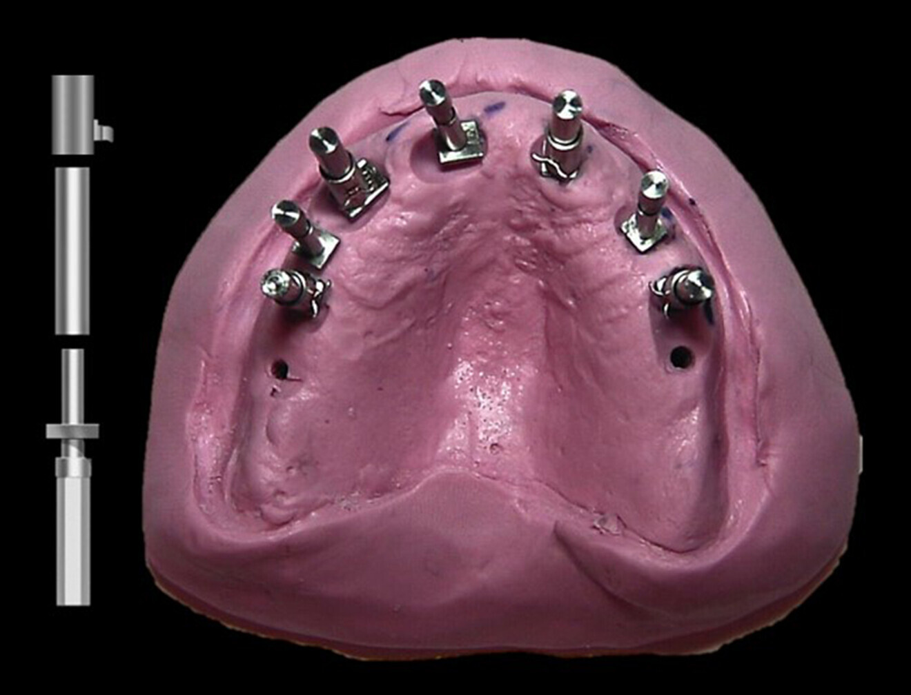 Fig. 14: Guided sleeves of 3 mm in depth placed on each of the upper removable parts of the guide posts to accommodate the 3 mm depth drill stops that would be utilised during surgery.