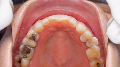 US agency reinstates rule on amalgam management