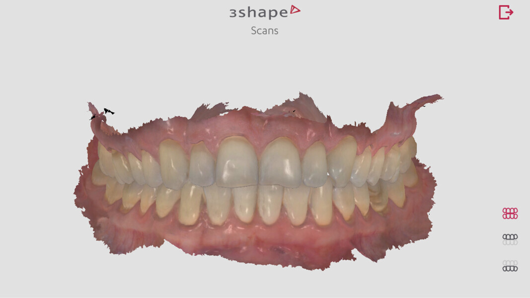 Fig. 4 : Scan intra-oral des dents de la petite-fille de la patiente.