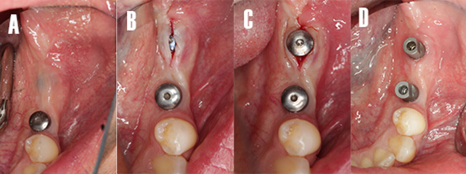 Figura 13. Fase protÃ©sica. A) A las 12 semanas de la cirugÃ­a de implantes, se realizÃ³ una segunda cirugÃ­a para colocar el pilar de cicatrizaciÃ³n a nivel de 3.7. B) Pilar de cicatrizaciÃ³n atornillado. C) A los 15 dÃ­as se procede tomar registros de impresiÃ³n con un escÃ¡ner intraoral. NÃ³tese los scan-bodies en posiciÃ³n. 