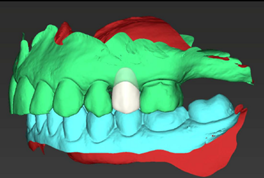 Figs. 5a–f: 3D images of the proposed treatment plan, including the surgical guides and healing abutments.