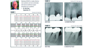 Waterlase REPAIR Perio: A minimally invasive solution for periodontitis management