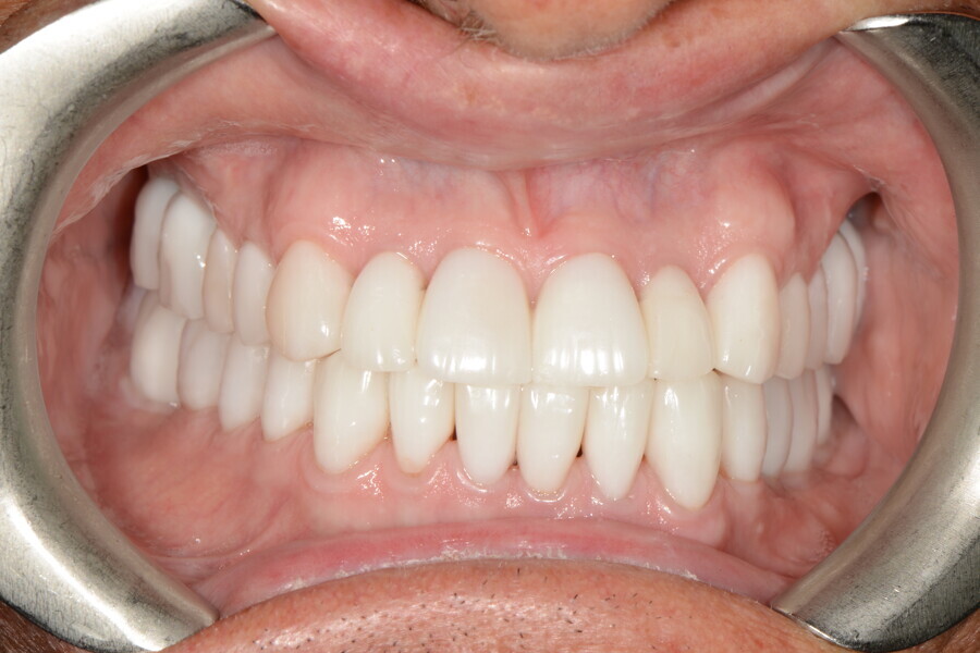 Fig. 32e: Fig. 32e: Teeth in intercuspal position.
