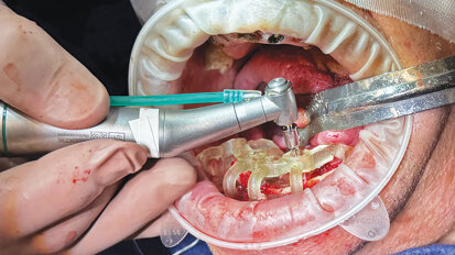 Precision and predictability with NeoBiotech’s NaviGuide Guided Surgery System