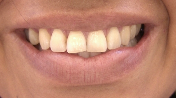 El alargamiento incisal