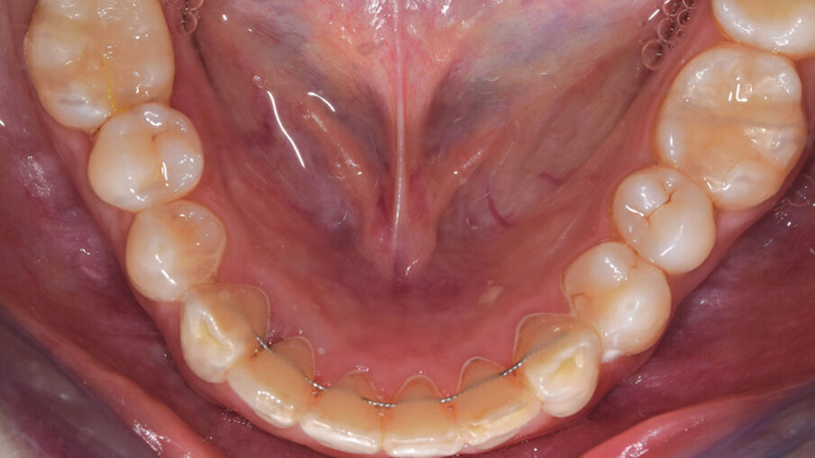 Figg. 9a-9c_Esami radiografici dopo il trattamento, con sovrapposizione sul piano SN. Questo ci mostra come, non potendo proclinare ulteriormente gli incisivi inferiori oltre la sinfisi per sfruttare l’intrusione relativa, l’apertura del morso è stata ottenuta sfruttando al massimo solo movimenti di intrusione assoluta, seppur minimi, e movimenti di intrusione relativa superiore ed estrusione posteriore parziale, considerando la difficoltà di quest’ultima, a causa della tipologia brachifacciale della paziente.