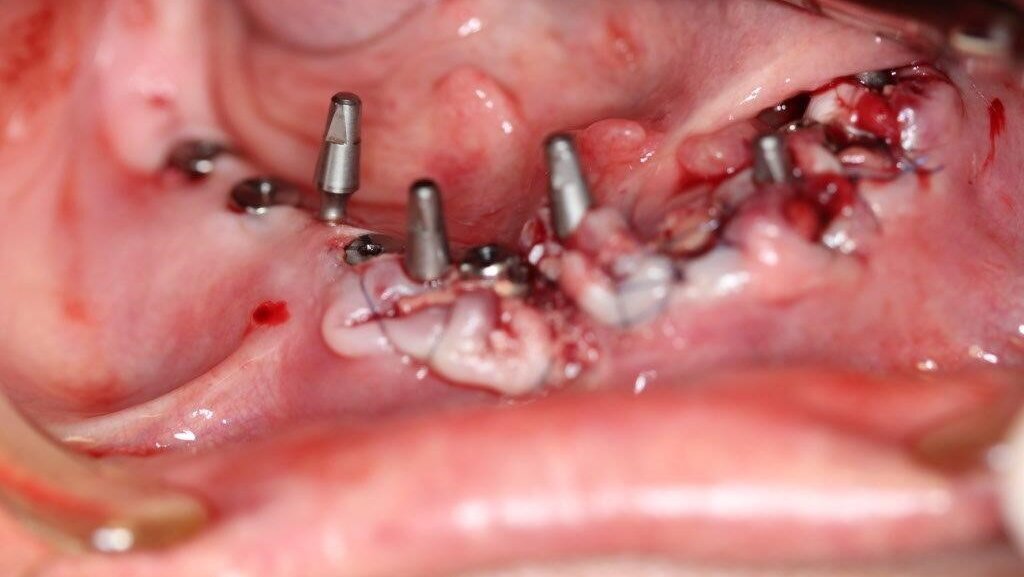 Implantacja z wykorzystaniem szablonu nawigacyjnego 3D – opis przypadku