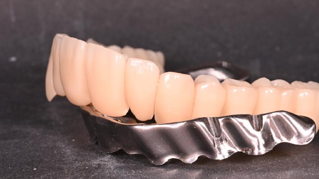 OT Bridge: protesi fisse complesse ma possibili con CEPROSEM e CIMsystem
