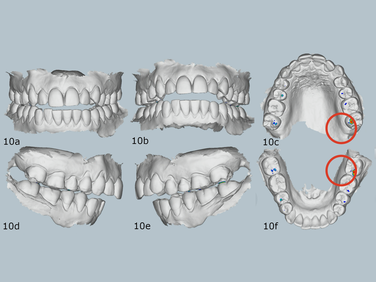 Figs. 10a–f: Relationship at the first contact in the arc of closure.