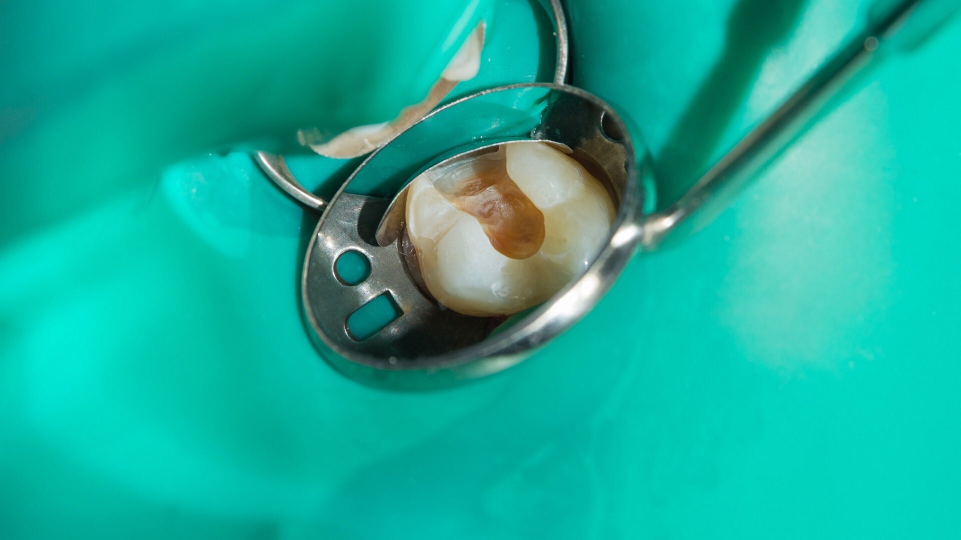 Successful endodontics—how to effectively use modern endodontic solutions in everyday practice