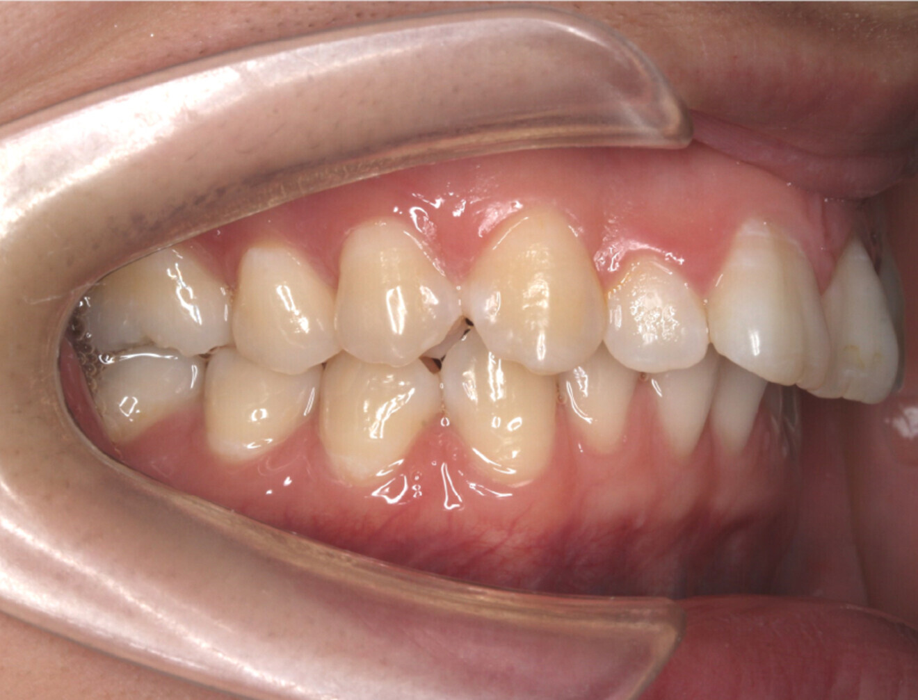 Fig. 1d: Lateral intra-oral view.