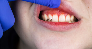 New at-home test for gingivitis