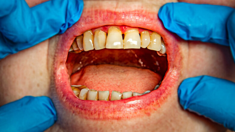 Periodontitis may double chances of cognitive decline, study says