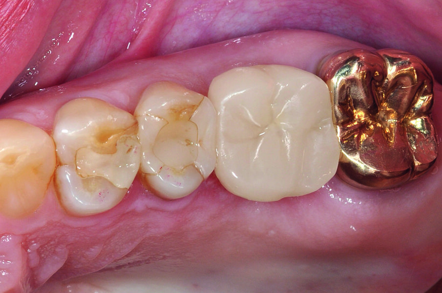 Fig. 15: After the closure of the screw channel with composite, this is no longer visible.