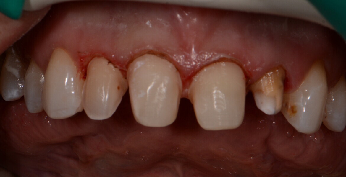 Fig. 7: Prepared teeth with gingival retraction ready for intra-oral scanning.