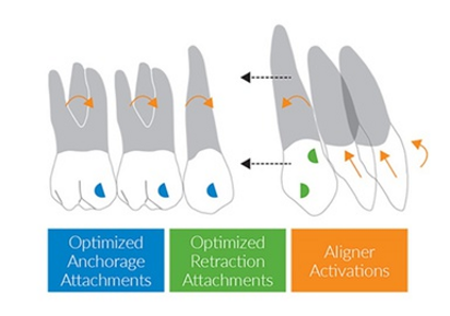 Invisalign G6