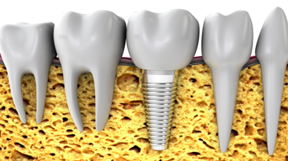Forscher stellen Bio-Hybrid-Implantat vor