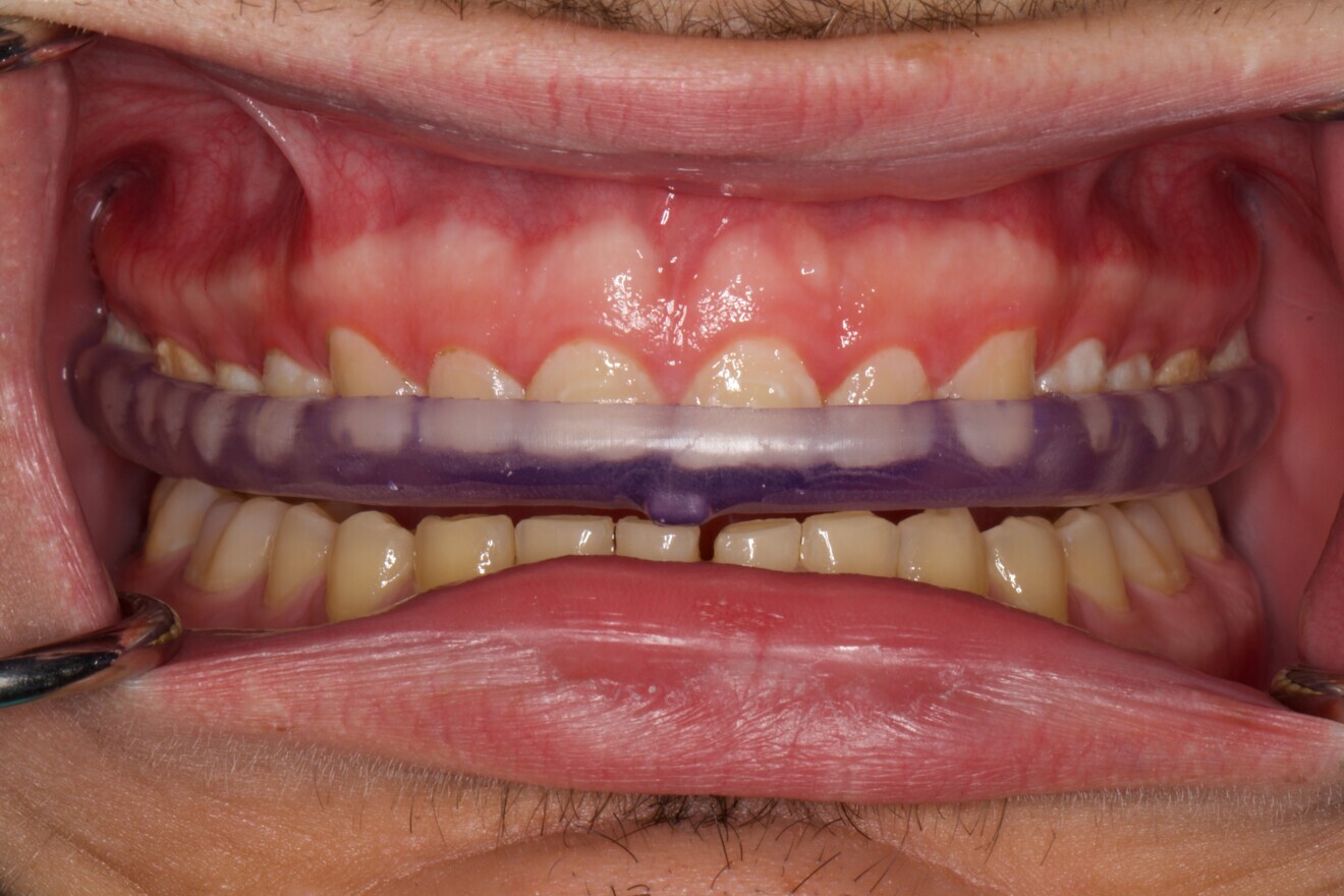 Fig. 14: Occlusal splint delivered to the patient.