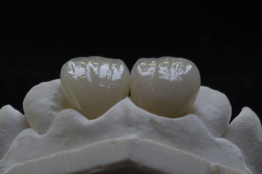 Figg. 3-5 - Stessa tecnica di tessitura eseguita su materiali diversi: denti in ceramica e in resina.