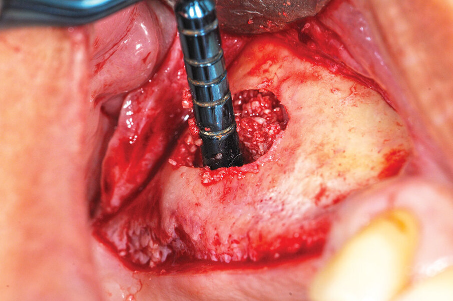 Fig. 4: ‘Gummy bone’ being placed into a lateral window sinus augmentation, allowing better placement against the medial, distal and mesial walls of the elevated sinus.