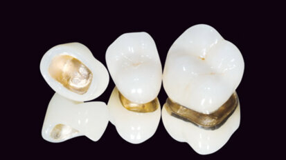 Un nouvel alliage Platine/Palladium/Or pour les restaurations conjointes