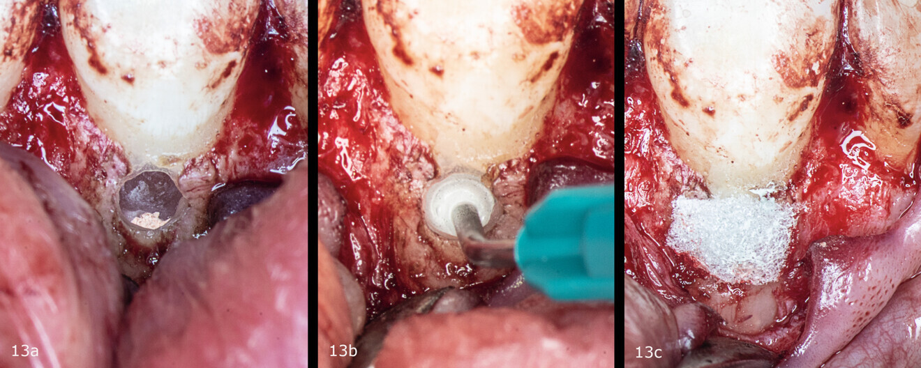 Figs. 13a–c: Application of the biomaterial in the resorption cavity and placement of collagen sponge on top.