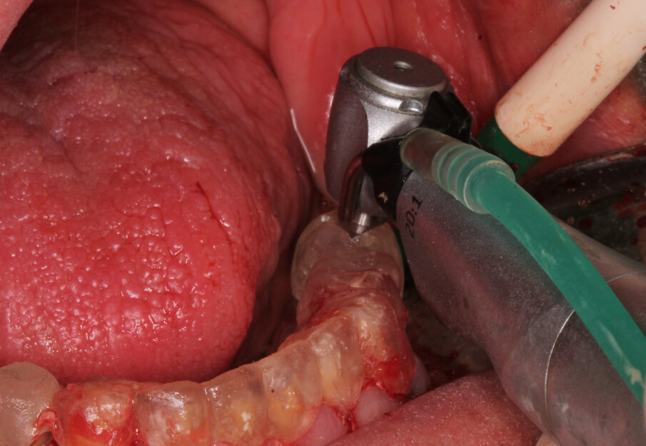 Fig. 11: Insertion of the implants with the help of the guiding template
