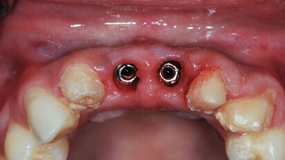 Implant uncovery with the Picasso diode laser