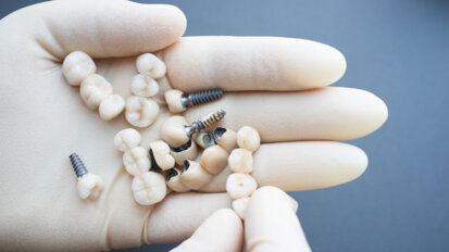 German researchers develop high-strength material for dental crown